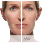 Быстрое омоложение лица для женщины