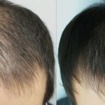 Плазмолифтинг волос для мужчин